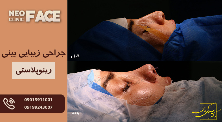 جراحی زیبایی بینی (رینوپلاستی)