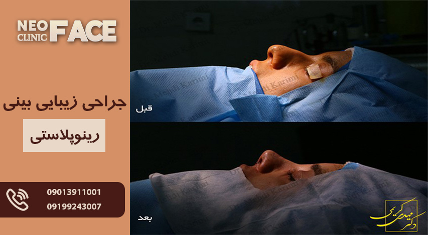 جراحی زیبایی بینی (رینوپلاستی)