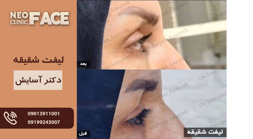 لیفت شقیقه چیست؟