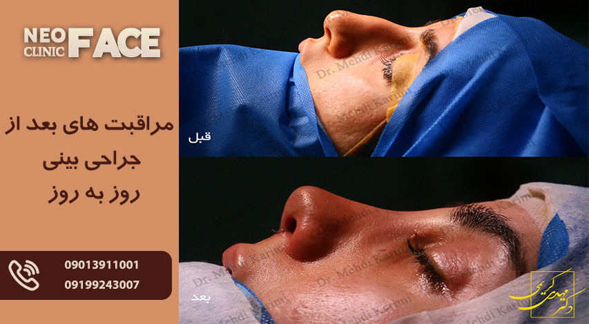 مراقبت های بعد از جراحی بینی